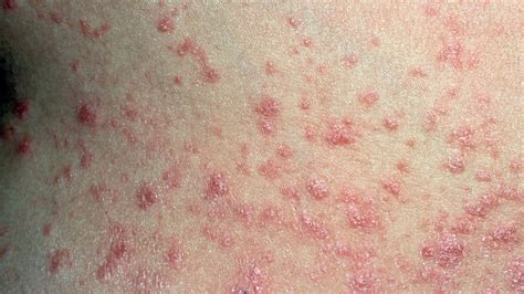 What Is Guttate Psoriasis Symptoms And Treatment Everyday Health
