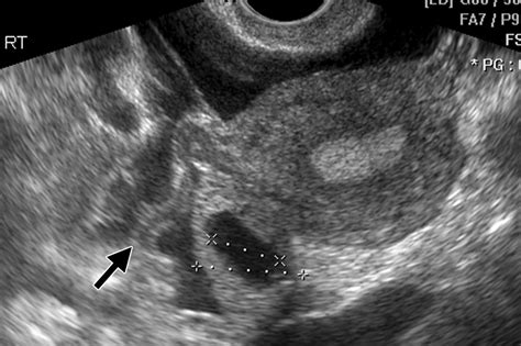 Fallopian Tube Disease In The Nonpregnant Patient Radiographics