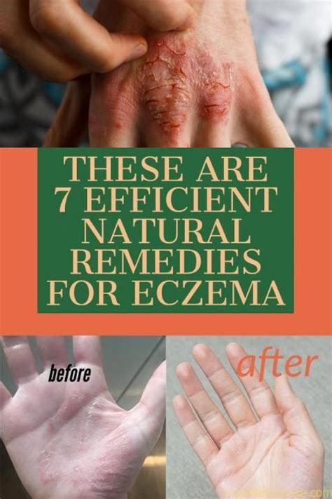 7 Effective Natural Treatments For Eczema My Healthy Poke