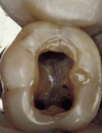 Mandibular First Molar Endo Access