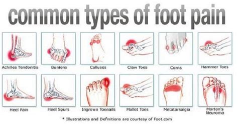 Often, a corn develops where a toe rubs against a shoe or. Types Of Foot Pain And How To Get Rid Of It ...