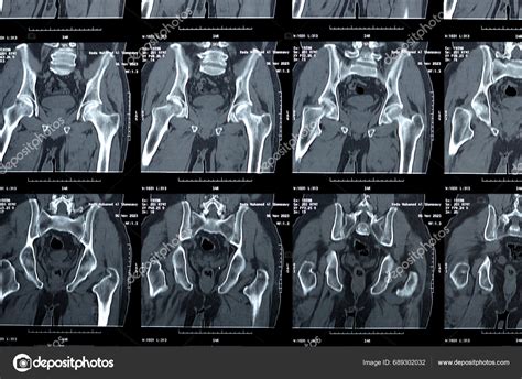 Cairo Egypt November Non Enhanced Scan Pelvis Revealed Grade