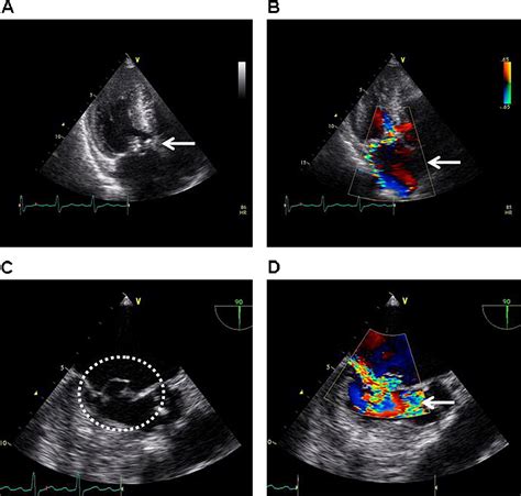 Infective Endocarditis Complicated By Mycotic Aneurysm Of A Coronary