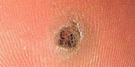 Photos Of Plantar Warts How To Remove Moles Warts Skin Tags Safely