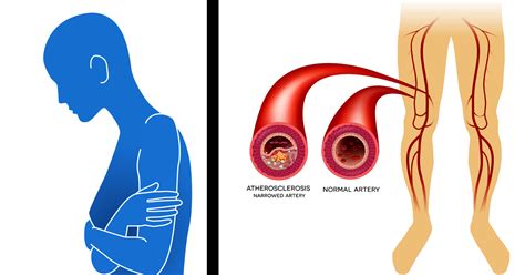8 Signs And Symptoms You Have Poor Circulation And Peripheral Artery