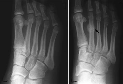 What Are Stress Fractures Of The Feet Sutherland