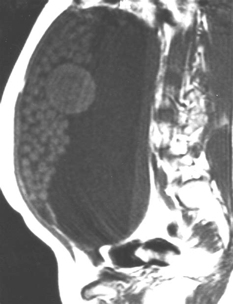 Multiple Mobile Spherules In Mature Cystic Teratoma Of The Ovary Ajr