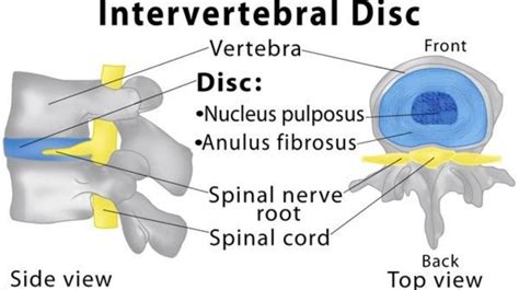 Prolapsed Intervertebral Disc Details Made Easy Specially For You
