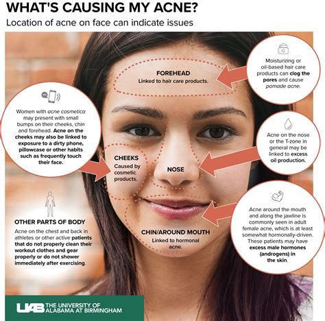 Acne Around The Mouth Acne Cosmetica How To Get Rid Of Pimples