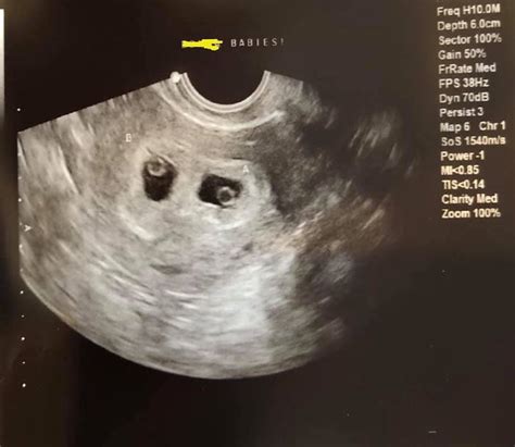 Early Twin Pregnancy Ultrasound