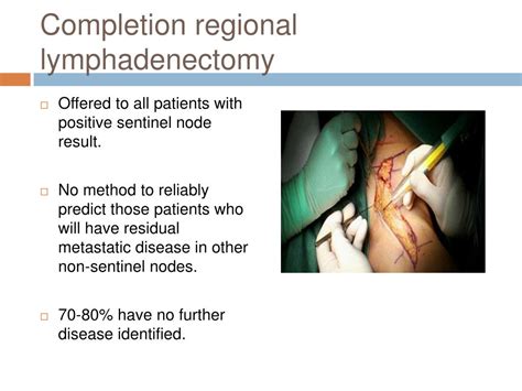 Ppt Sentinel Lymph Node Biopsy In Melanoma Powerpoint Presentation