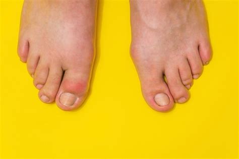 How To Treat Gout Of The Big Toe The Orthopaedic Foot And Ankle Center