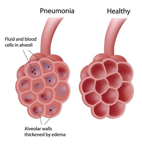 Inflammation From Bacterial Pneumonia What Is Pneumonia Pneumonia