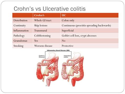 Ulcerative Colitis Vs Crohns Pin By Michele Gunn Mitchell On Crohns