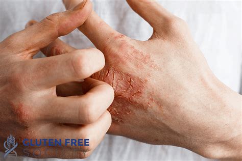 Gluten Allergy On Skin Gluten Free Society