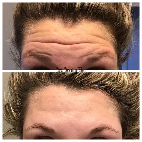 Botox Before And After My Botox Experience