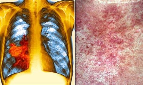 Lung Cancer Symptoms Signs Of A Tumour Include An Itchy Rash On Your