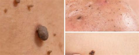 Skin Tags And Moles General Skin Signature Medispa Skinpro Skin