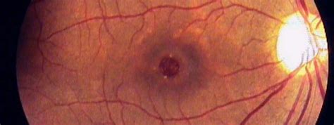 Macular Hole Repair Retina Orange County