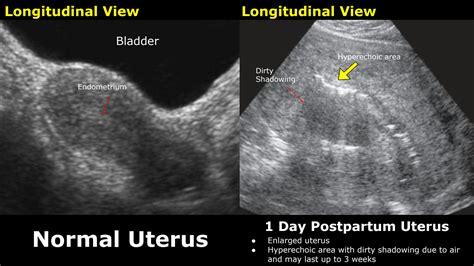 Solution Postpartum Uterus Ultrasound Normal Vs Abnormal Studypool