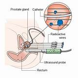 Pictures of Side Effects Of E Ternal Beam Radiation For Prostate Cancer