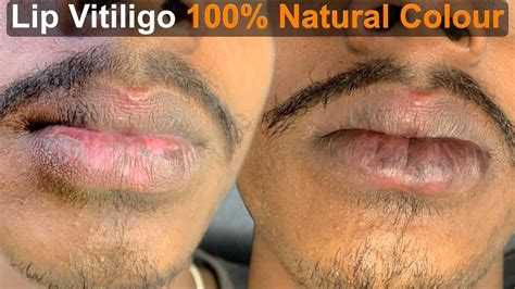 Permanent Lip Vitiligo Treatment No Side Effects Machu Tattoo