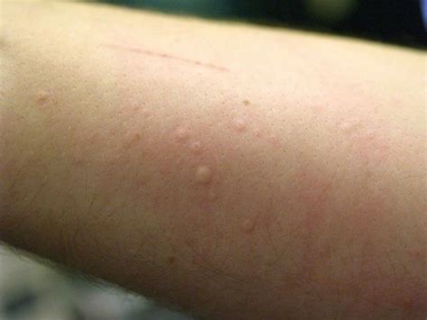 Do Your Mosquito Bites Sting And Swell You Could Have ˜skeeter Syndrome
