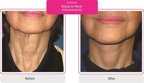 Botox Photos Before And After Results Skinviva Manchester