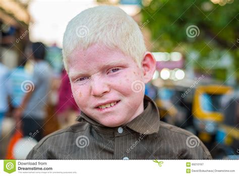 Indian Albino Boy In Mangalore Editorial Photography Image Of