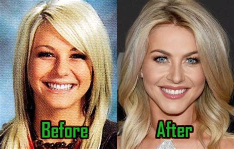 Julianne Hough Nose Job Before And After