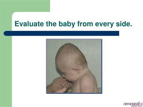 Ppt The Orthotic Management Of Infants With Deformational