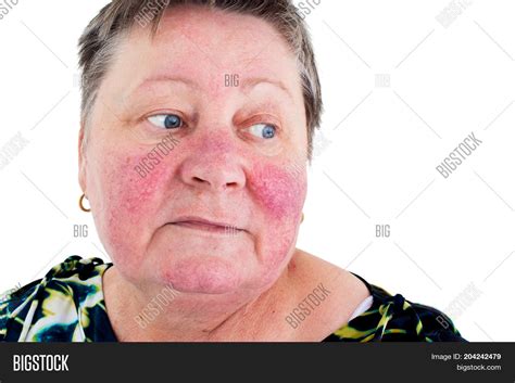 Rosacea Facial Skin Image And Photo Free Trial Bigstock