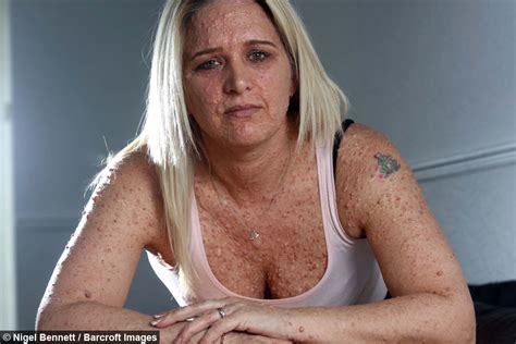 Neurofibromatosis Leaves Mums Body Covered In Lumps