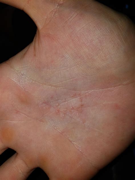 Small Lump In Palm Of Hand