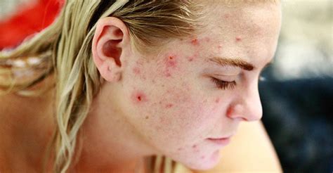 Acne Breakout Heres What To Do About It Ponbee