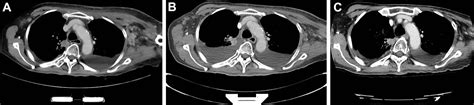 Histologic Transformation In A Patient With Lung Cancer Treated With