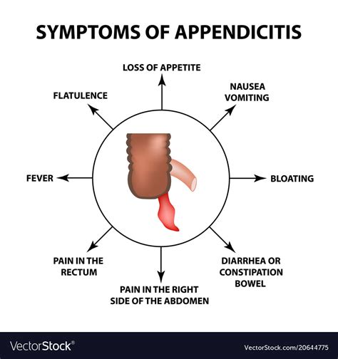 Symptoms Of Appendicitis Inflammation Appendix Vector Image