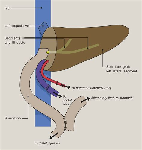 Paediatric Liver Transplantation An Overview Paediatrics And Child