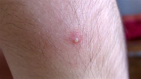 Pimple Like Sores On Body