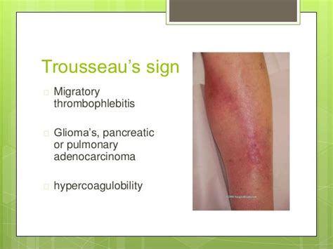 Thrombophlebitis Pictures Posters News And Videos On Your Pursuit