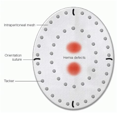 Umbilical Epigastric Spigelian And Lumbar Hernias Basicmedical Key