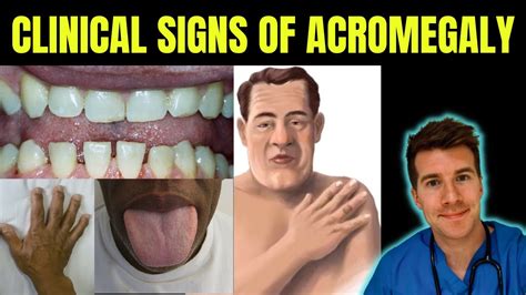doctor explains signs and symptoms of acromegaly gigantism including prognathism frontal