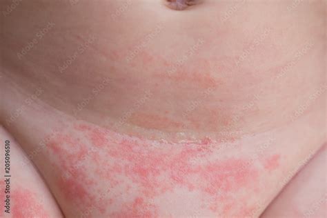 Yeast Diaper Rash And Dermatitis On The Belly Of A Newborn Baby Stock