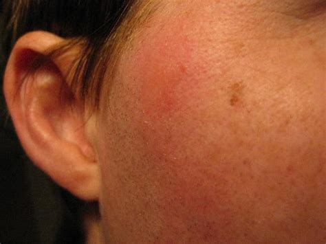 Luxury 50 Of Bed Bug Bite Pictures On Face Phenterminecodp
