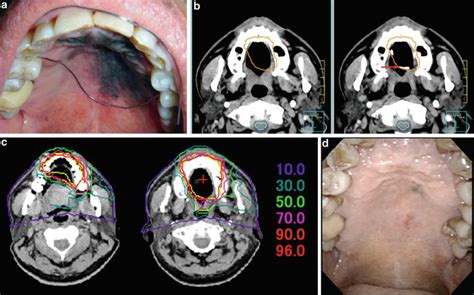 Malignant Melanoma Of The Head And Neck Radiology Key