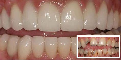 Gum Disease Treatment Hertfordshire Bow House Dental