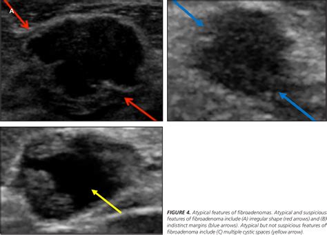 Figure 4 From Fibroadenoma From Imaging Evaluation To Treatment