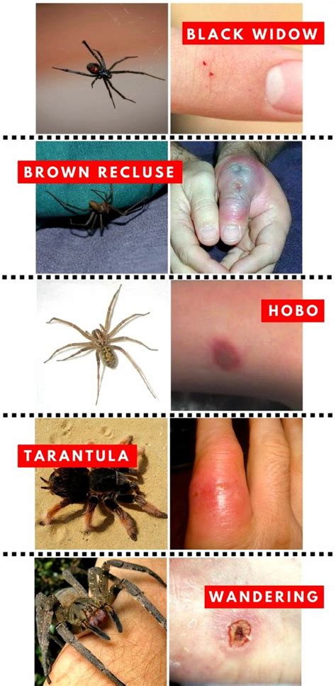 A Guide To Different Spider Bites And The Symptoms They OFF