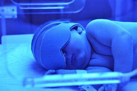 5 Cara Mengatasi Penyakit Kuning Pada Bayi Baru Lahir