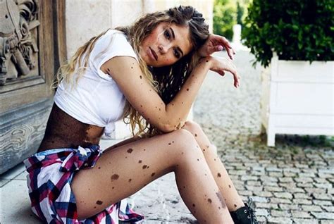 Beautiful Woman Who Was Bullied For Her Birthmarks Inspires Others With